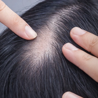 Graft-implantation-process